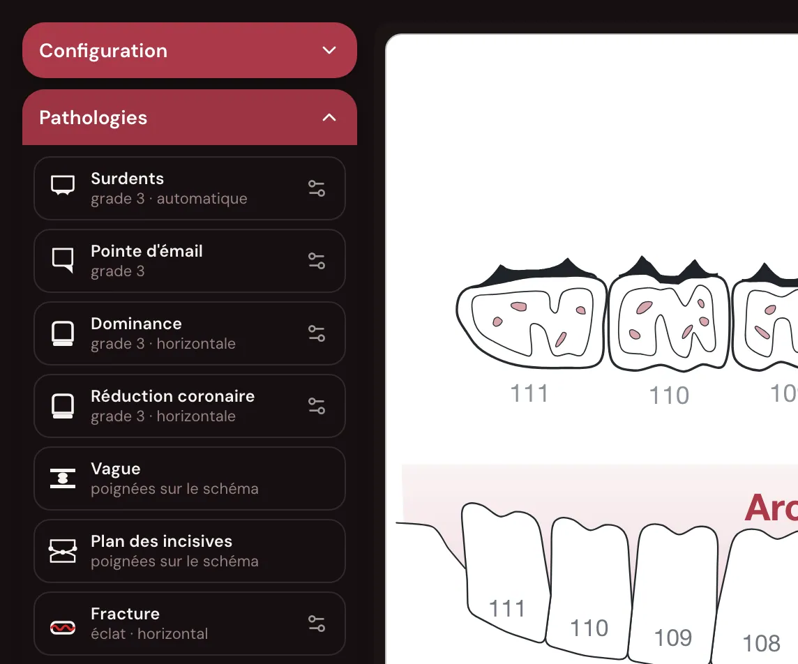 La carte Pathologies ouverte à côté du schéma : Surdents grade 3 automatique, Pointe d’émail grade 3, Dominance et Réduction coronaire grade 3 horizontale, Vague et Plan des incisives par poignées sur le schéma, Fracture éclat horizontal, chacune avec l’icône de son réglage
