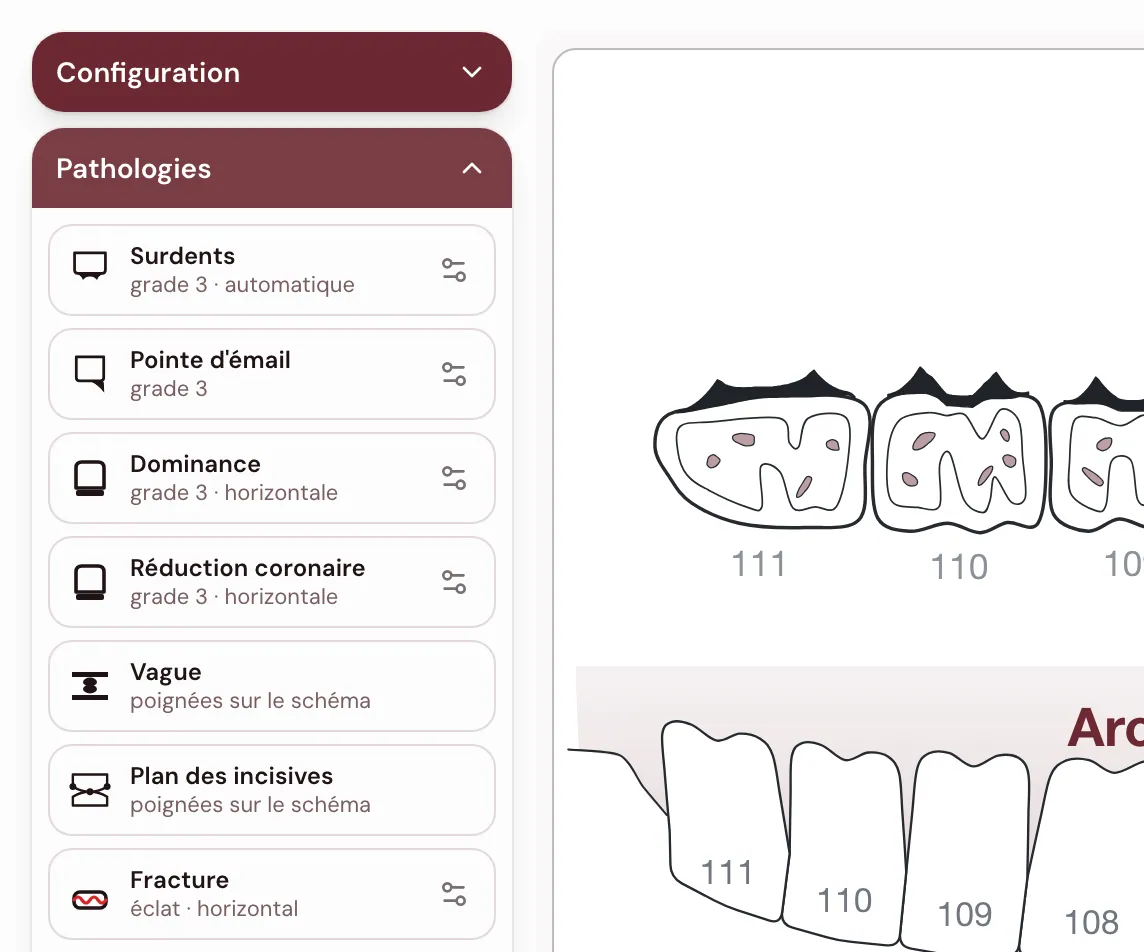 La carte Pathologies ouverte à côté du schéma : Surdents grade 3 automatique, Pointe d’émail grade 3, Dominance et Réduction coronaire grade 3 horizontale, Vague et Plan des incisives par poignées sur le schéma, Fracture éclat horizontal, chacune avec l’icône de son réglage
