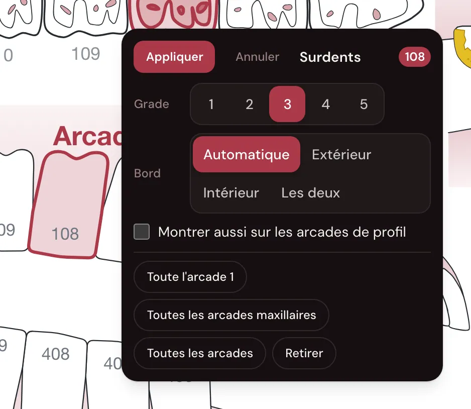 La carte Surdents collée à la 108 : le grade de 1 à 5, le bord Automatique, Extérieur, Intérieur ou Les deux, Toute l’arcade 1, Toutes les arcades maxillaires, Toutes les arcades, et le bouton Appliquer