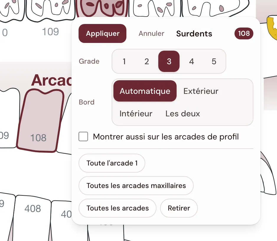 La carte Surdents collée à la 108 : le grade de 1 à 5, le bord Automatique, Extérieur, Intérieur ou Les deux, Toute l’arcade 1, Toutes les arcades maxillaires, Toutes les arcades, et le bouton Appliquer