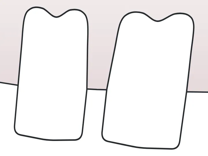 Diastème dessinée sur une dent du schéma