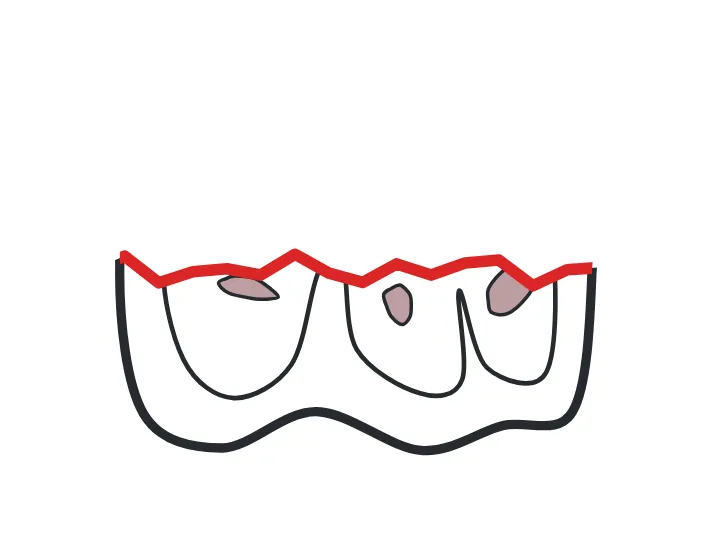 Fracture dessinée sur une dent du schéma