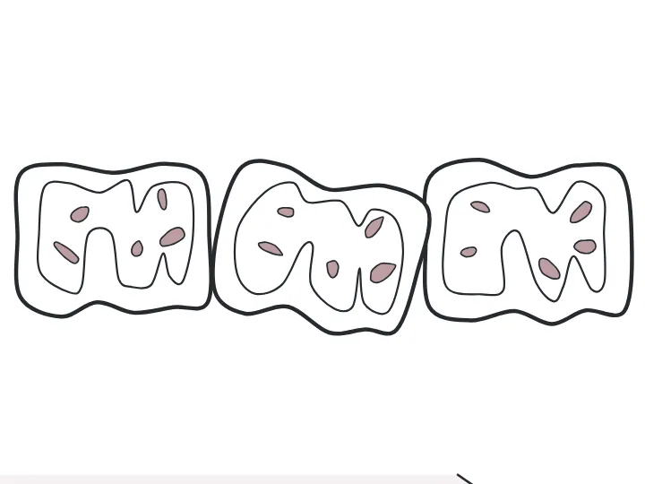 Désalignement dessinée sur une dent du schéma