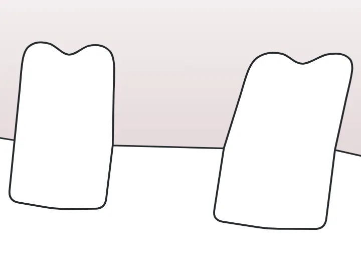Oligodontie dessinée sur une dent du schéma
