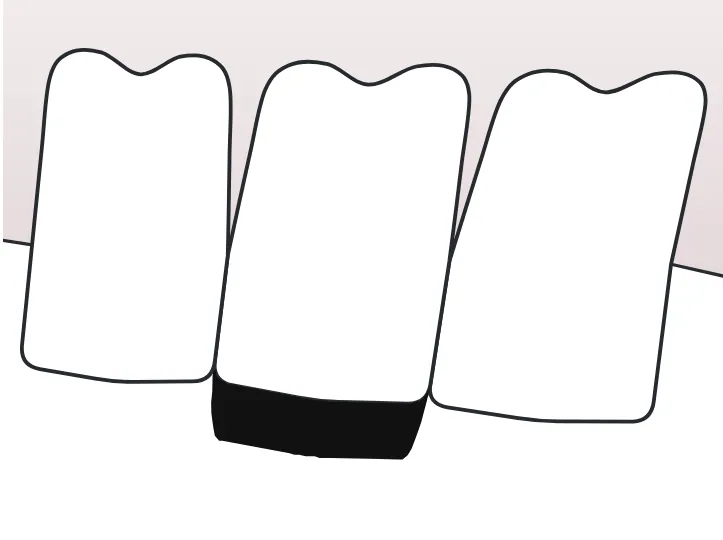 Dominance dessinée sur une dent du schéma
