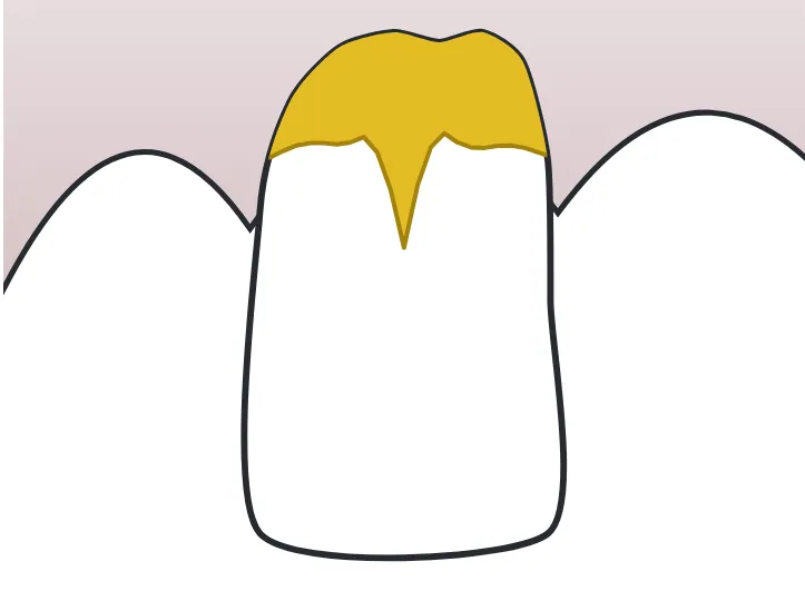 Tartre dessinée sur une dent du schéma