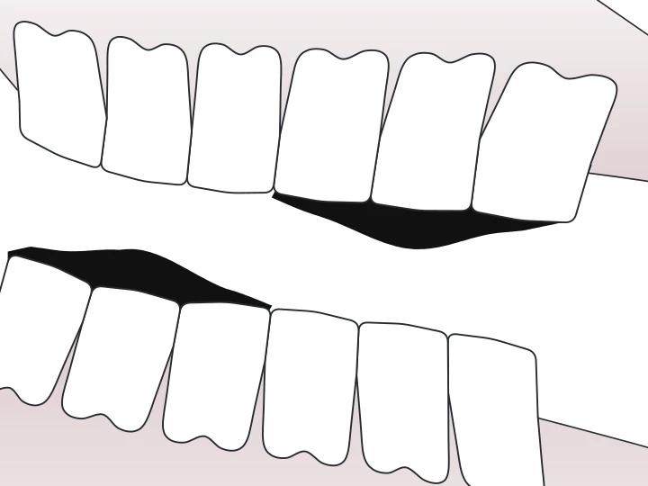 Vague dessinée sur une dent du schéma